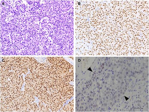 Figure 1 Immunohistochemical staining of TdT in seminomas. Seminomas are characterized by diffuse sheets or nests of tumor cells separated with lymphocytic infiltration; tumor cells have relatively uniform and large nuclei, prominent nucleoli, and abundant clear or eosinophilic cytoplasm (A). Tumor cells were diffusely and strongly positive for TdT (B) and confirmed by OCT4 (C). Old archived tissues may lose TdT antigen to varying degrees and therefore give a misinterpretation of “negative” staining for TdT (D, highlighted between the black arrowheads) (amplification: 10×20, bar=50μm).