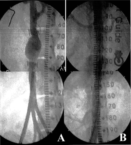 Figure 9 Angiographies: before the deployment of the stent-graft to isolate the prosthetic aneurysm (A) and after the deployment of the device (B).