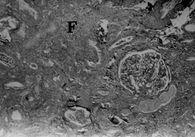 Figure 1. Photomicrograph of the kidney biopsy showing focal dilatation of proximal tubules with granular casts and lining of low cuboidal epithelium of regenerating epithelium. The glomerulus is unremarkable. There is patchy tubular atrophy with interstitial fibrosis (F). (H&E ×120).