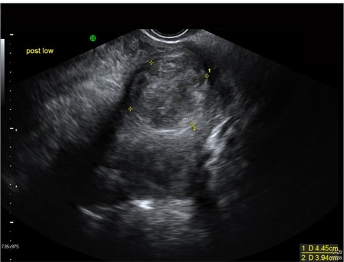 Figure 1 A 37-year-old Afro-Caribbean woman with a history of menorrhagia. Transvaginal ultrasound image showed a bulky fibroid uterus with multiple intramural fibroids. The largest fibroid (pictured above) is at the fundus on the posterior wall measuring 4.5 × 4 cm.