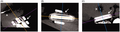 Figure 2. Sagittal (A), Axial (B), and coronal (C) planes through the ultrasound transducer (arrow A–C) created with multiplanar reconstruction. The coronal plane (C) was used to replicate the ultrasound plane by aligning the axial plane (purple line) with the ultrasound transducer face. This allowed equivalent in plane gas and hypoattenuating zone measurements of the ablation zone (arrowhead A, C).