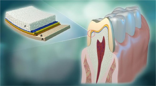 Figure 1 The bonding interface structure of zirconia restoration to tooth substrate.Notes: (A) Zirconia that makes the crown; (B) the red spherical particles constitute the alkaline coating; (C) MDP-containing primer or adhesive; (D) composite resin cement; (E) dentin adhesive; (F) dentin.Abbreviation: MDP, 10-methacryloyloxydecyldihydrogenphosphate.