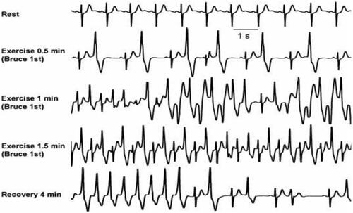 Figure 4 BiVT developing following 1 min of exercise in a patient with CPVT, arrhythmia resolved following resting. Reproduced from Burns E, Buttner R. Bidirectional Ventricular Tachycardia (BVT). Available from: https://litfl.com/bidirectional-ventricular-tachycardia-bvt-ecg-library/. Creative Commons license and disclaimer available from: http://creativecommons.org/licenses/by/4.0/legalcode.Citation34