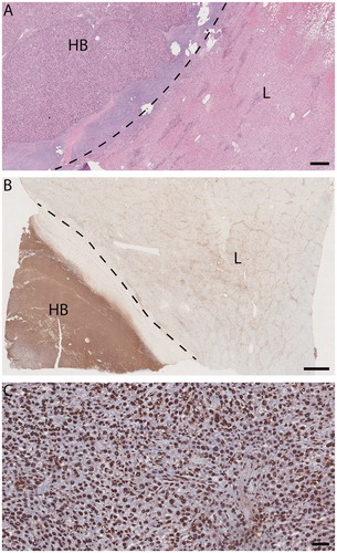 Figure 3. Light micrographs, explanted liver (patient 1) with SRFA-treated HB. (A) and (B) HB (HB hepatoblastoma, L adjacent liver). Dotted line, tumor pseudocapsule. A viable-appearing tumor and background liver. Hematoxylin/eosin, size bar, 500 µm. (B) Immunohistochemical evidence of response to injury much more pronounced in tumor than in background liver. TUNEL staining size bar, 2 mm. (C) HB: tumor-cell, endothelial and fibrocyte nuclei alike are marked TUNEL positive, indicating apoptosis in both tumor and stroma. TUNEL staining size bar, 50 µm.
