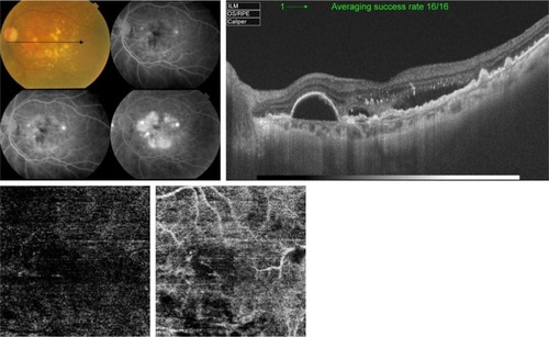 Figure 8 Upper left, color photo and FFA of the left eye of a 66-year-old female with intermediate AMD and extensive drusen. The late frames of FFA show pooling in multiple PEDs and LLIO characteristic of occult CNV. Upper right, corresponding SS-OCT image in radial scan mode shows RPE detachment. The RPE is irregular, thickened, and raised-up by a moderately hyper-reflective lesion with accumulation of sub-retinal fluid, suggestive of type I CNV formation. Lower, “en face” SS-OCTA image of the same eye taken at the level of the outer retina in a 3×3 mm field (left) and co-registered OCT segmentation slabs (right). The absence of identifiable decorrelation signal characteristic of abnormal vascular network formation in the area of suspicious CNV formation is shown.