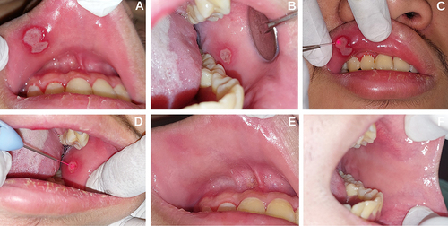 Figure 1 A 24-year-old male with RAS. (A and B) Ulcers at first visit on the right upper labial mucosa and left buccal mucosa. (C and D) Application of PBM to ulcers. (E and F) Lesion at the third visit (day 21) showed an improvement.