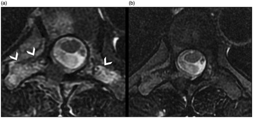 Figure 3. Same case as in Figure 1: (a) pre- and (b) post-treatment T2 FAT SAT MRI, showing bone oedema around the lesion (arrowheads) and disappearance during follow-up.