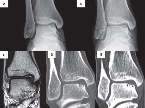 Figure 2. A 29-year-old man with OCL. (A) Initial standing radiograph and (C) initial MRI showed medial OCL. (D) CT at 1-year follow-up, (B) standing radiograph and (E) CT at 9-year follow-up showed no change in lesion size. The AOFAS ankle–hindfoot score improved from 92 to 100.