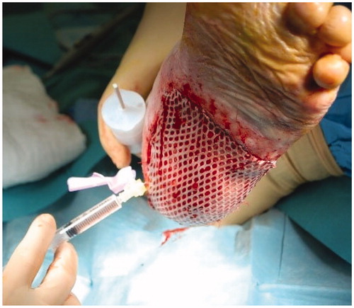 Figure 2. Injection of solution containing autologous micrografts obtained with Rigenera® protocol.