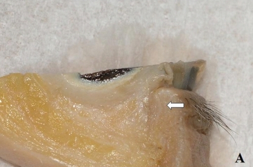 Figure 2A With a complete sagittal incision, the vertical portion of the lacrimal canaliculus is interrupted at the halfway point and so the distal part of the canaliculus is not included here.