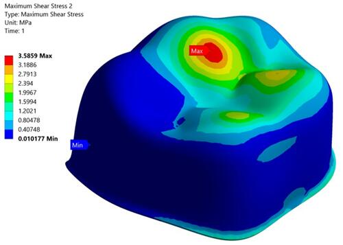 Figure 11 Maximum shear stress at the dentin-adhesive interface at the static load.