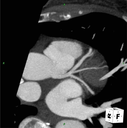 Figure 1 Illustration of thin MIP reconstruction of left coronary artery.