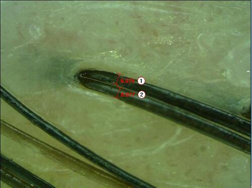 Figure 3 The diameter of posterior occipital hair follicles examined by trichoscope before operation.
