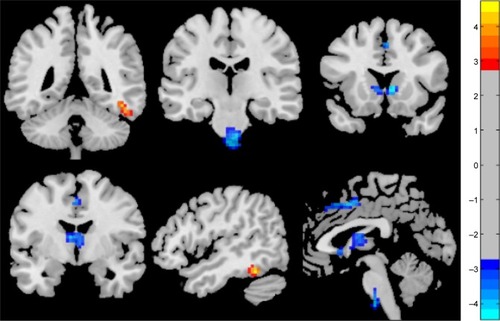 Figure 1 Different regional brain areas between patients with RRMS and HCs.