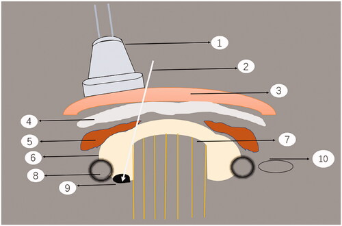 Figure 1. Schematic diagram of ultrasound-guided percutaneous thermal ablation of HPT. 1. Linear array probe used for guiding and positioning; 2. ablation needle; 3. skin and subcutaneous soft tissue; 4. fascia tissue; 5. anterior cervical muscles; 6. thyroid gland; 7. trachea; 8. carotid artery; 9. hyperplastic parathyroid gland; 10. internal jugular vein.