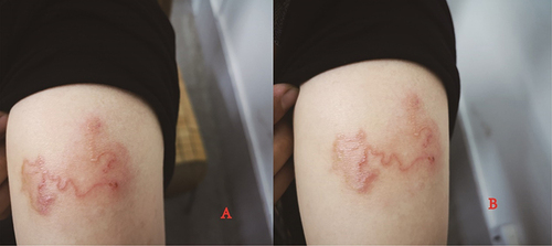 Figure 1 Clinical presentation of the patient on admission (A and B) dark red, linear, spiral patches on the lateral side of the upper arm).