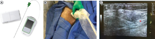 Figure 2. Peripheral nerve stimulation lead placement procedure.Fine-wire coiled percutaneous leads with an external stimulator and remote (A) were implanted under ultrasound guidance. This example shows a lead placement targeting the femoral nerve (B). After identifying the optimal location using a test stimulation needle, the leads were placed approximately 1–3 cm distant from the femoral and sciatic nerves (C).