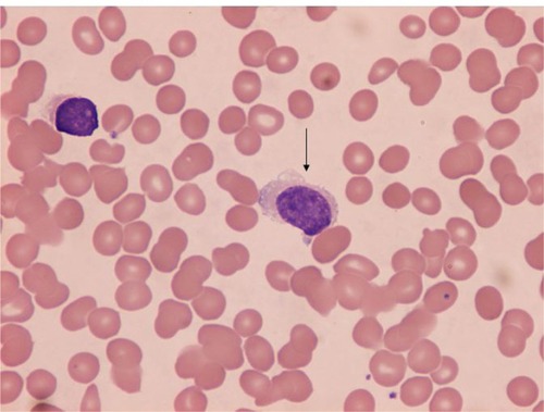 Figure 1 Classical hairy cell lymphocyte (arrow) seen in peripheral blood.