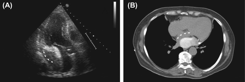 Figure 2. Transthoracic echocardiogram and chest computed tomography suggestive of a loculated and localized haemopericardial effusion compressing the left atrium and left lower pulmonary vein (arrowheads).