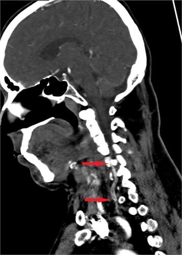 Figure 3 A coronal view of computed tomography angiography scan showing a long, fresh, free-floating thrombus in V1 and V2.