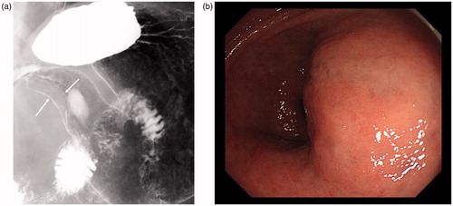 Figure 2. (a) Barium examination, (b) endoscopic image. Gastric lesion is described as compression of the gastric lumen (a: arrows) and submucosal mass projecting into the lumen at the antrum (b). Overlaying mucosa is normal on each examination.