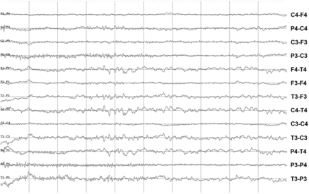 Figure 2. Normal beta wave brain activity in a control horse showing the channels indicating the location of the electrodes. The electrical activity recorded on each electrode was compared to the indifferent one. Electrical difference between electrode sets are graphically visualised on the computer screen. F = frontal, C = central, P = parietal and T = temporal. The electrodes on the left side of the horse's head are odd numbered, on the right side even numbered and those on the midline are named ‘z’. Scale: 50 μV/division and 1 second/division.