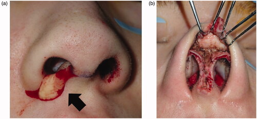 Figure 2. Intraoperative findings. (a) A water-soluble specimen in the wound region, indicated by the arrow. (b) At the completion of debridement.