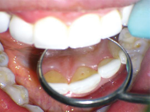 Figure 24. Intra oral picture of 0.8 mm diameter access hole.