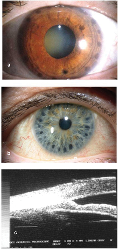 Figure 2. (a) Slit lamp photograph of an eye with plateau iris syndrome after ALPI. The dark, round laser marks can be clearly seen on the peripheral iris. (b) ALPI burns being placed too centrally, and thus ineffective. (c) UBM showing ALPI being placed too centrally, and the angle remains closed.