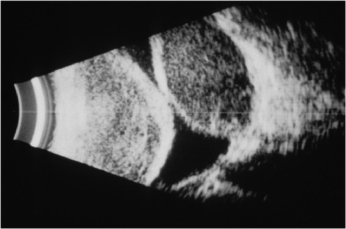 Figure 2 B-scan echography demonstrating an example of appositional suprachoroidal hemorrhage.