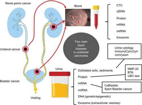 Figure 1 Main liquid biopsies in urothelial carcinoma of the bladder and upper urinary tract carcinoma