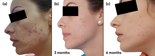 Figure 13 Case study 6 improvement on left-hand side of face, baseline to 6 months. (a) No response after 6 months with spiro 100 mg / day + tretinoin 0.05% gel at night. (b) 3 months with bicalutamide 50 mg / 3 times per week + AZA 15% gel twice daily. (c) 3 months with bicalutamide 50 mg two times per week + AZA 15% gel twice daily.