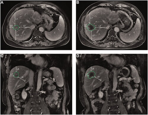 Figure 1. The axial (A,C) and coronal (B,D) images showing the measurement process of the minimal ablative margin. The distances (L1–L7) are measured from the edge of the tumor to the selected anatomical landmarks in the pre-RFA magnetic resonance (MR) images, and then the corresponding distances (L1′–L7′) are measured from the ablation edge to the same landmarks in the post-RFA MR images. The differences between the corresponding distances are determined, and the smallest value among the seven differences is selected as the minimal ablative margin. RFA: radiofrequency ablation.