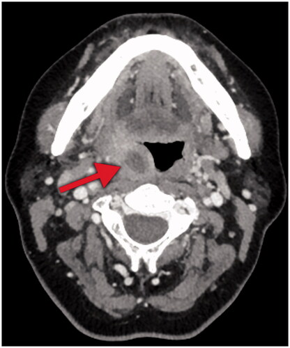 Figure 3. Computed tomography in the axial plane of the patient in case 2. Note the intratonsillar lesion (arrow) with low attenuation on the right side, measuring 13x9x20 millimeters, indicating an abscess.
