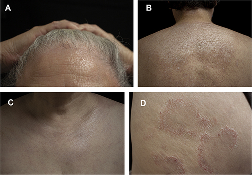 Figure 1 (A–C) Depigmented spots on the hairline, posterior occipital, upper back, and anterior neck, with superficial atrophy. (D) Right scapular circular red annular patch with a few white scales on the surface and central regression.