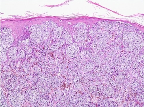 Figure 1 Melanoma of superficial spreading type.Notes: Atypical melanocytes are spread within the epidermis and located in the dermis; hematoxylin and eosin stain, ×100.