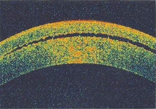 Figure 1 Anterior segment optical coherence tomography of the interface fluid as optical space between the corneal flap and the stroma.
