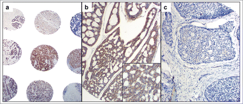 Figure 2. c-MET expression was seen in inner ductal cells and outer myoepithelial cells with a cytoplasmic and membranous pattern of staining.