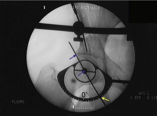 Figure 8. The angle measuring disc for measurement of the center-edge angle. It is positioned by recognizing the center of the femoral head and the lateral limit of the sclerotic acetabular roof as landmarks (blue arrows). The 0° mark is labeled. The measured angle in this case is 35° (yellow arrow).