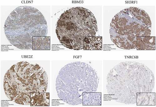 Figure 4. The immunohistochemistry of significant genes(CLDN7, RBM33, SH3RF1, UBE2Z, FGF7 and TNRC6B) in BC