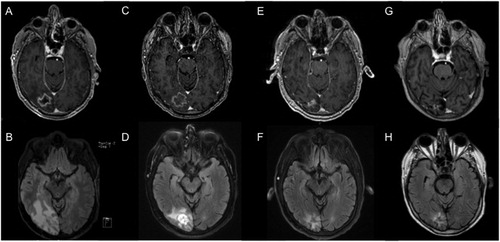 Figure 1. Serial MRI of case illustration patient undergoing LITT. Pre-operative (A) T1-weighted post-contrast MRI demonstrating a contrast enhancing lesion within the right occipital lobe with perilesional edema on (B) T2-weighted FLAIR MRI. Two weeks after LITT, the lesion showed (C) stable enhancing size but (D) decreased surrounding edema, accompanied by further decreases at 6-month follow-up in both (E) lesion size and (F) perilesional edema. At last follow-up 43 months after LITT, the ablated lesion showed (G) minimal nodular enhancement and (H) near-resolution of surrounding edema.