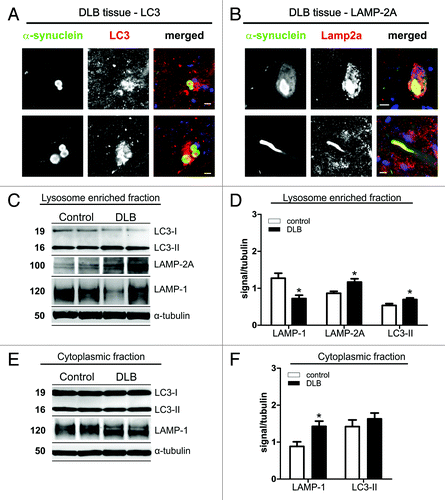 Figure 1. Immunohistochemistry for LC3 (A) and LAMP-2A (B) in α-synuclein positive Lewy bodies (LBs) in midbrain of DLB patients. Co-staining for both ALP markers was found in LBs. In addition, LAMP-2A was found in Lewy neurites (B, lower panel). Scale bars: 10 µm. Protein levels of LAMP-1, LAMP-2A and LC3 in cell lysates (lysosome enriched fraction, C and D; cytosolic fraction, E and F) of temporal cortex tissue of DLB cases and controls. Western blot analysis of ALP marker is shown for two representative DLB cases and controls (C and E). Quantitative densitometry revealed increased levels of LC3-II and LAMP-2A in the lysosome enriched fraction (D; DLB n = 12, controls n = 9), but not in the post-nuclear fraction (F; DLB n = 15, controls n = 11; D, upper panel). A LAMP-2A specific signal could only be detected in the lysosome enriched fraction. LAMP-1 was reduced in the lysosome-enriched fraction and increased in the post-nuclear fraction. (Student’s t-test, *p < 0.05).