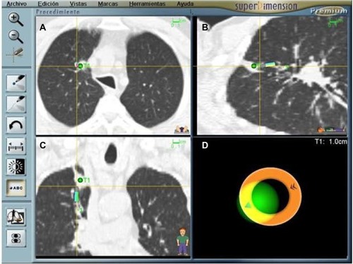 Figure 2 ENB procedure screen capture showing that an adenocarcinoma has been reached (green dot); (A–C) Sagittal, coronal, and axial views. The nodule is quite central and difficult to reach. (D) Indicates distance to the target and probe’s position. The patient required a preoperative diagnosis in order to be eligible for a clinical trial.