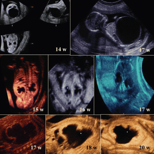 Figure 52.  Huge bladder before and after vesicoamniotic shunt (VAS) operation. (left upper) 3D orthogonal view at 14 weeks of gestation. Huge bladder and bilateral hydronephrosis are demonstrated. Abdominal wall is not fragile like prune-berry syndrome. (right upper) sagittal image at 17 weeks before VAS. Bladder volume is 137.7 ml. (middle figures) Changing appearance of kidneys at 15,16 and 17 weeks from the left. Rapid thinning of renal parenchyma with progressive hydronephrosis is clearly demonstrated. (lower figures) Changing appearance of renal parenchyma (17, 18, and 20 weeks from the left) after VAS operation performed at 17 weeks. Renal parenchyma thickness was rapidly recovered after VAS procedure, with improvement of hydronephrosis [72].