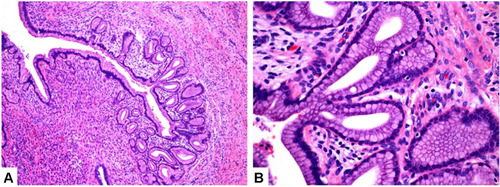 Figure 4 Lobular endocervical glandular hyperplasia (LEGH). Lobular endocervical glandular hyperplasia (LEGH) is also called cervical gland phyllodes hyperplasia. The phyllodes hyperplasia is generally located on the upper half of the cervical epithelium, and the glands are well differentiated. At a smaller magnification, the nuclei gather at the base like a necklace. ((A), magnified ten times) Gastric type differentiated glands, no fibrous reaction and inflammatory cell infiltration ((B), magnified forty times).