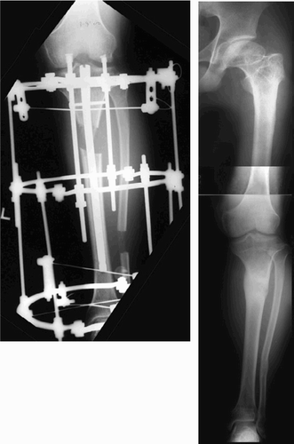 Figure 5. Distraction osteogenesis with an external fixator over an intramedullary nail (right). After removal of external fixator and intramedullary nail, showing normal alignment of the mechanical axis of the leg (right).