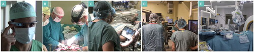 Figure 5. Examples of display types used for MR IGS. (A) Google Glass allows for the projection of simple images/text in the corner of the glasses [Citation25]. (B) The HoloLens HMD displays holograms of preoperative plans and anatomy in the surgical field of view in an abdominal cancer surgery case [Citation28]. (C) An iPad device used to show an AR view of the patient anatomy in neurosurgery [Citation42]. (D) The monitor of the neuronavigation system is used to show the AR view [Citation29]. (E) The surgical microscope’s HUD can be used to show the AR view in the oculars [Citation17].