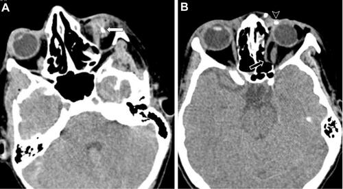 Figure 4 (A) 31-year-old man with left globe rupture with secondary mechanism. Non-contrast computed axial tomography image shows intra-vitreal hemorrhage (white arrow) and globe rupture caused by intraocular foreign body in the left eye. (B) In a different patient, hemorrhagic density in the sclera and eyelid and shrapnel in soft tissue (arrowhead). In addition, herniation of the medial rectus muscle into the ethmoid sinus of the orbital medial wall (lamina papyracea) fracture is observed (black arrow) (combination of primary and secondary mechanism).