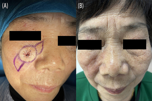 Figure 3 A 71-year-old woman had basal cell carcinoma on her nasofacial with a 2-year history. A biopsy was obtained from the skin lesion and confirmed the diagnosis. (A) Preoperative view of the patient. (B) Postoperative view 5 months after surgery.