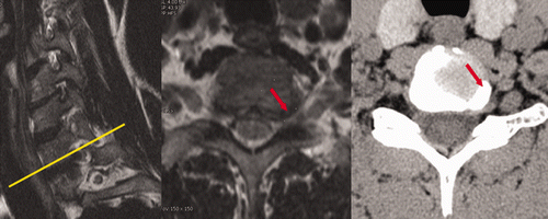 Figure 1. T2-weighted MRI showing a right lateral soft disc herniation at C7-T1 (red arrow). Left: sagittal foraminal view; center: axial view; right: CT axial view.
